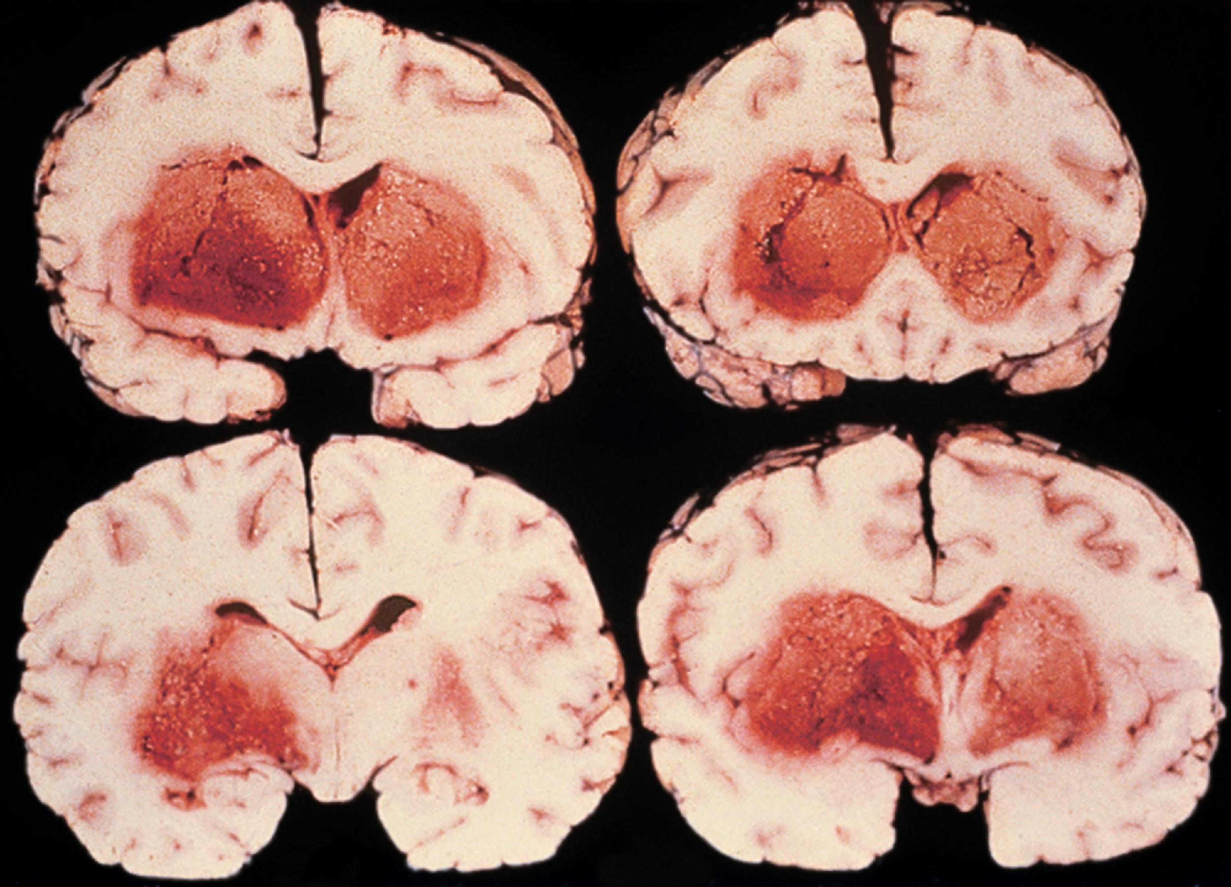 FIGURE 7.26, Mucormycosis. Hemorrhagic lesions are typical and most often involve the basal frontal lobes or the deep gray nuclei.