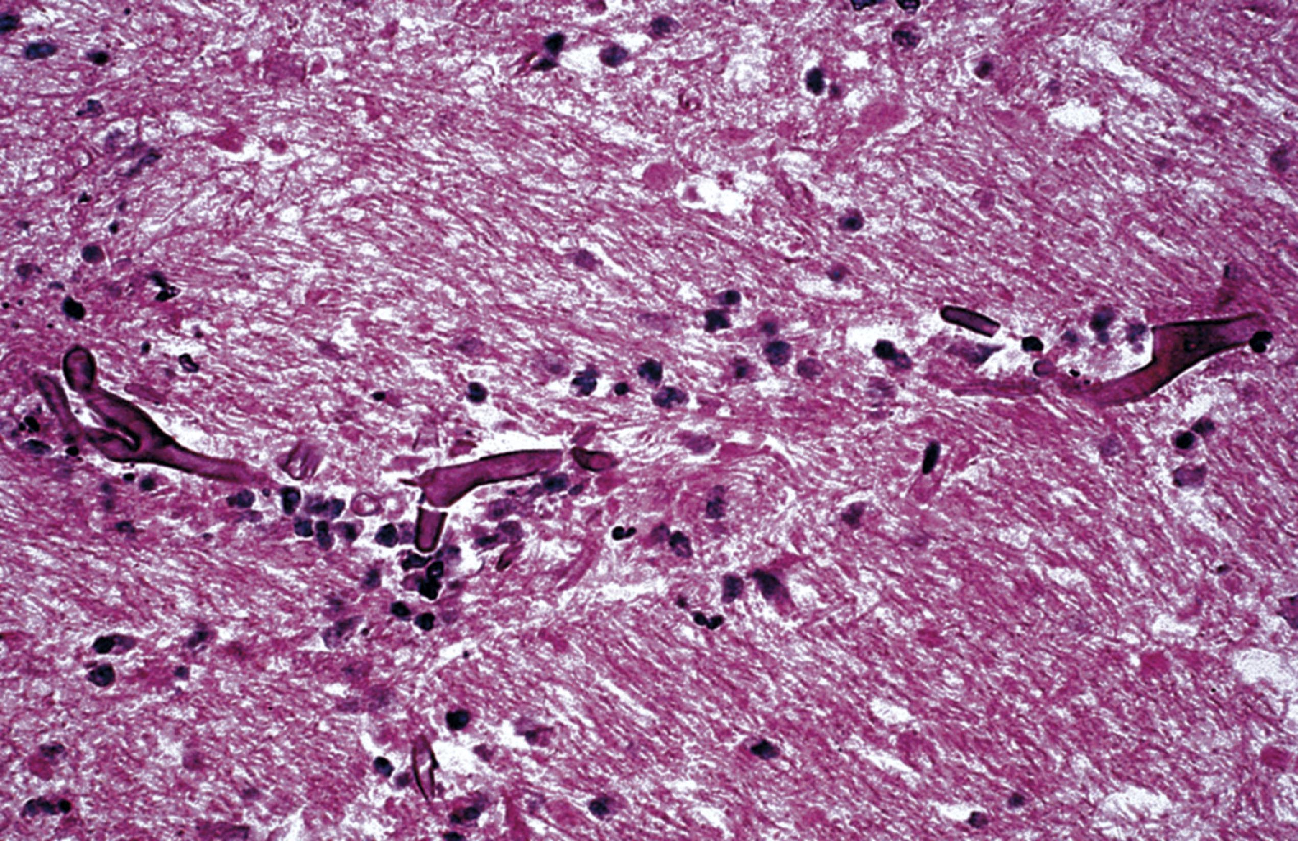 FIGURE 7.27, Mucormycosis. These organisms appear in tissue as nonseptate, ribbon-like hyphae that branch at right angles.