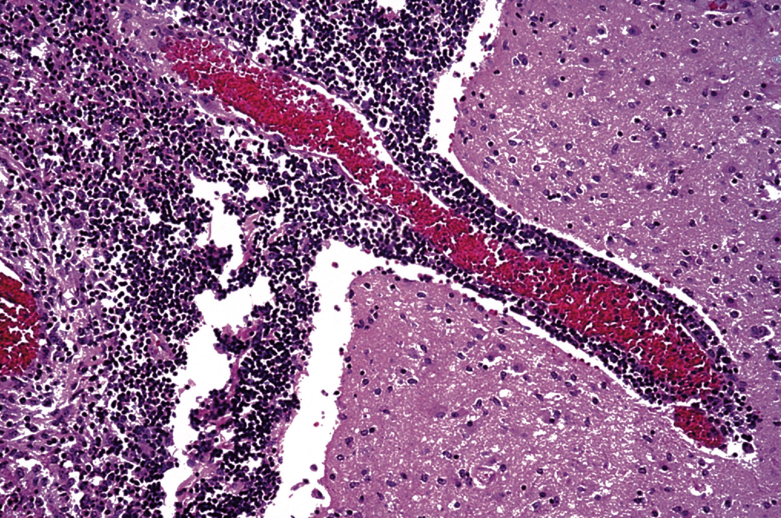 FIGURE 7.3, Meningitis. Neutrophils are present within the subarachnoid space and surrounding blood vessels in the Virchow-Robin spaces.