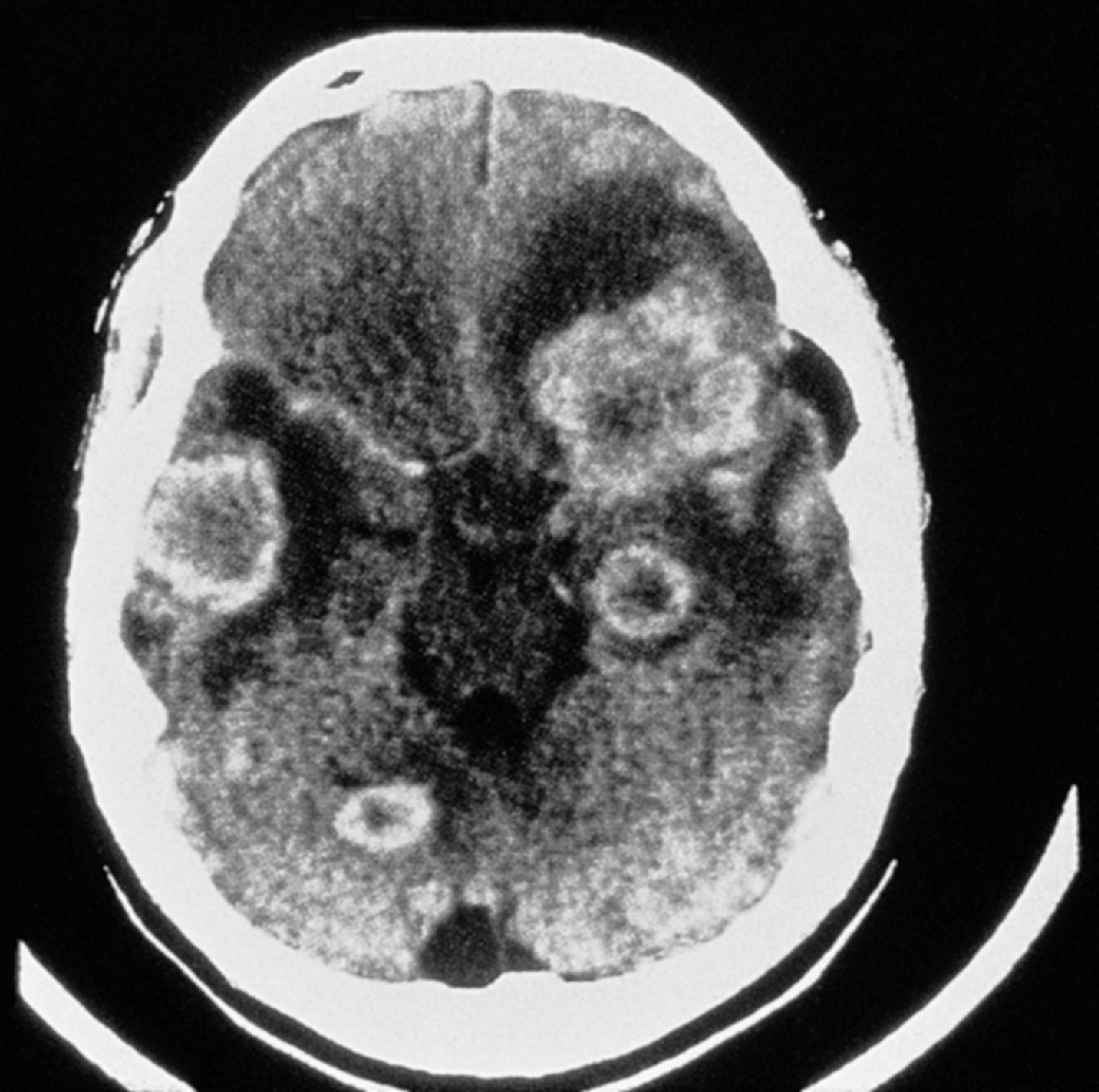 FIGURE 7.4, Brain abscess. A ring-like pattern of enhancement is evident in contrast-enhanced studies (CT scan).