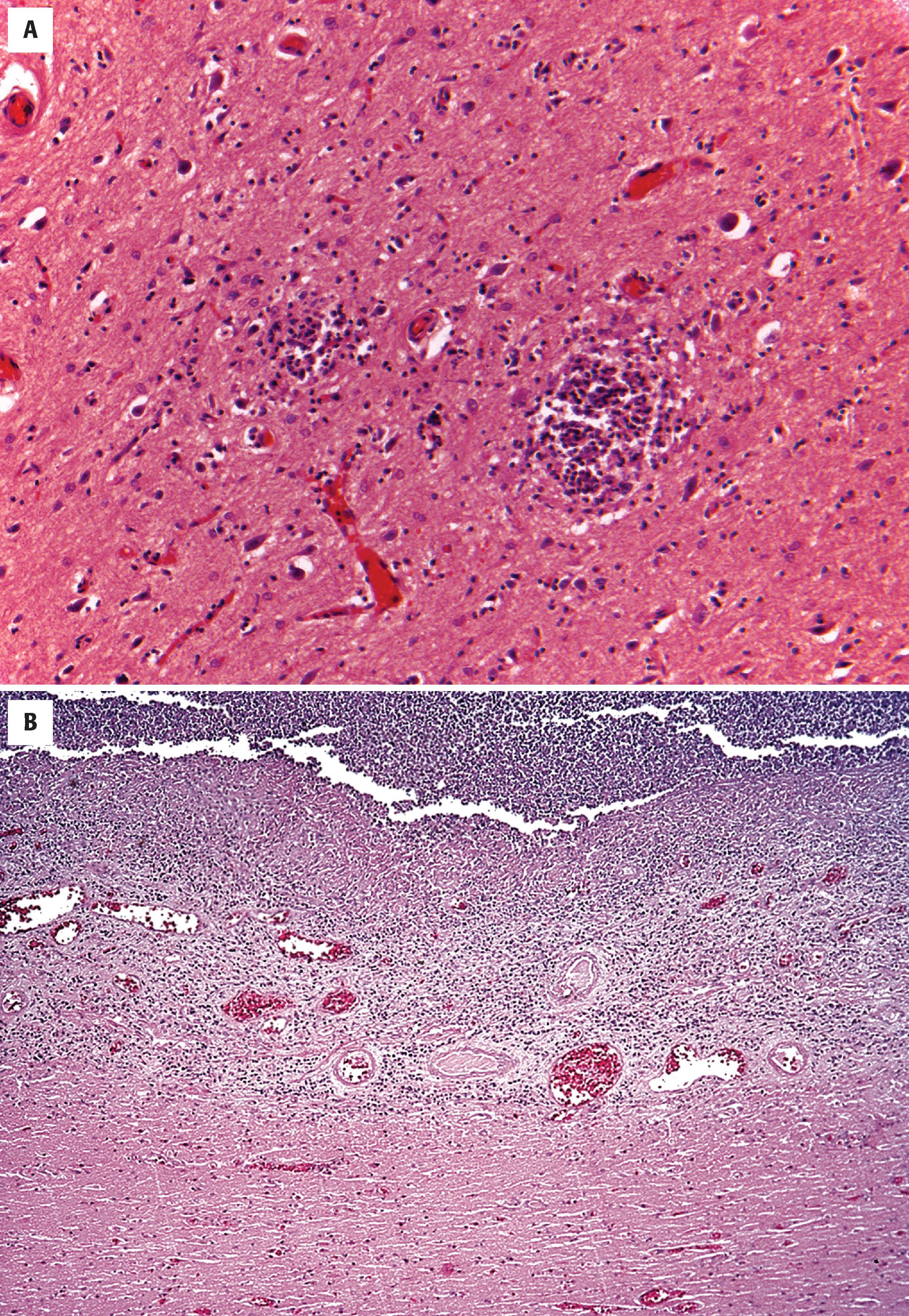 FIGURE 7.6, Brain abscess. A, Early abscesses are typified by small collections of neutrophils. B, Later, a region of central necrosis and inflammation surrounded by granulation tissue and gliosis is visible.