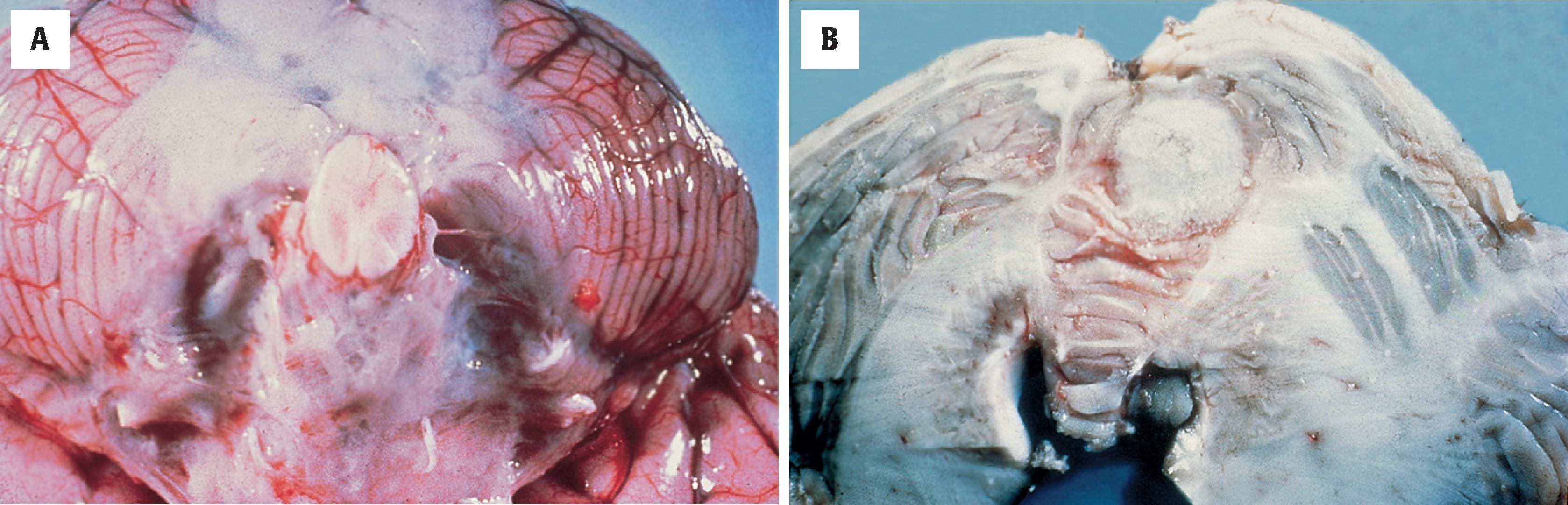 FIGURE 7.7, Tuberculosis. A, Tuberculous meningitis typically involves the base of the brain. Small nodules or tubercles may be identified within the exudate. B, Tuberculous infection of the CNS may also take the form of mass lesions or tuberculomas.