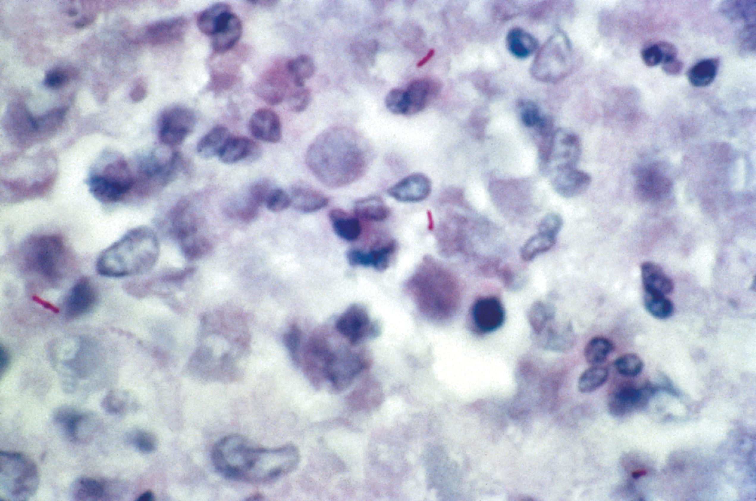 FIGURE 7.8, Tuberculosis. Acid-fast organisms, seen with a Ziehl-Neelsen stain, are often difficult to identify and should be searched for carefully in suspected cases of tuberculosis.