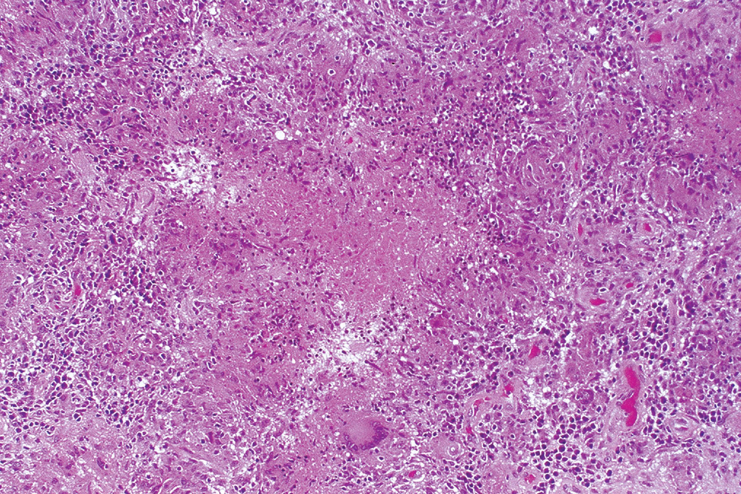 FIGURE 7.9, Tuberculosis. Necrotizing granulomatous inflammation is typical of this infection. Areas of central caseous necrosis are surrounded by an inflammatory infiltrate composed of epithelioid histiocytes, Langhans giant cells, and lymphocytes.