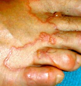 Fig. 2.17, Cutaneous larva migrans (‘creeping eruption’) due to larvae of animal Ancylostoma hookworms.