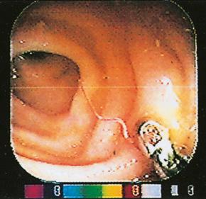 Fig. 2.18, Adult Ancylostoma caninum in human ileum.