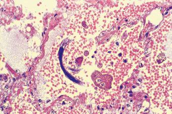 Fig. 2.25, Section of lung from a patient with disseminated Strongyloides stercoralis.