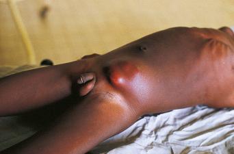 Fig. 2.32, ’Dapaong tumour’ in a Togolese boy.