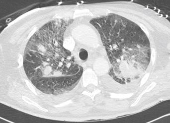 Fig. 2.06, Pneumonia due to melioidosis.