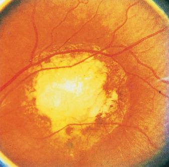 Fig. 3.102, Ocular larva migrans.