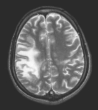 Fig. 3.12, Progressive multifocal leucoencephalopathy (PML).