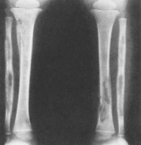 Fig. 3.17, Salmonella osteomyelitis of both tibias and fibulas in sickle cell anaemia.