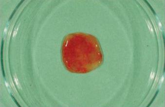 Fig. 3.19, Bloody, mucoid diarrhoea from a patient with shigellosis.