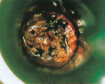 Fig. 3.21, Shigellosis affecting the sigmoid colon.