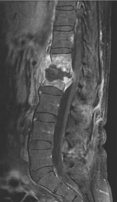 Fig. 3.36, Brucella spondylitis.