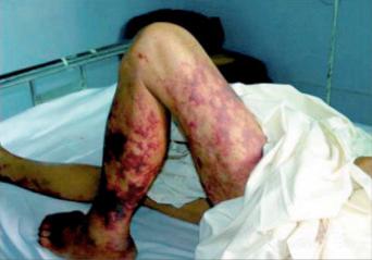 Fig. 3.37, Subcutaneous haemorrhage due to Streptococcus suis sepsis.