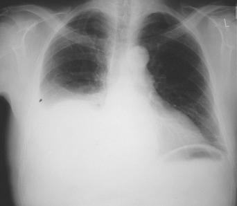 Fig. 3.44, Chest radiograph in a patient with an amoebic liver abscess.