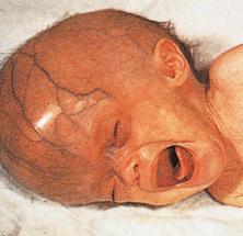 Fig. 3.54, Hydrocephalus in congenital toxoplasmosis.