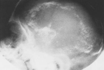 Fig. 3.55, Skull radiograph in congenital toxoplasmosis.