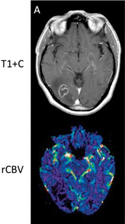 Fig. 3.57, Cerebral toxoplasmosis in HIV infection.