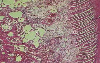 Fig. 3.58, Balantidial ileitis.