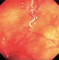 Fig. 3.60, Enterobius vermicularis visible at colonoscopy.