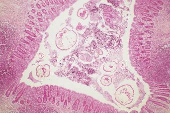 Fig. 3.62, Adult pinworms in appendix.