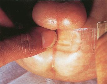 Fig. 3.63, Sellotape test to demonstrate perianal eggs.