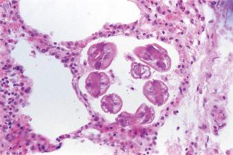 Fig. 3.71, Transverse sections of Ascaris lumbricoides larvae in the pulmonary alveoli.