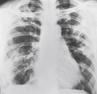 Fig. 3.72, Loeffler's syndrome.