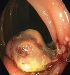 Fig. 3.82, Colonic anisakiasis.