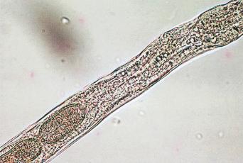 Fig. 3.86, Female Capillaria philippinensis from human faeces.