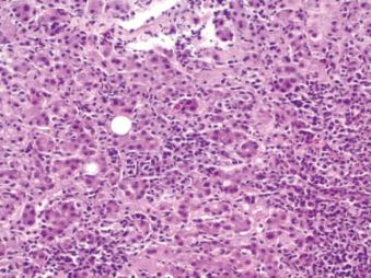 Fig. 3.9, Panlobular inflammation and lobular disarray due to hepatitis A.