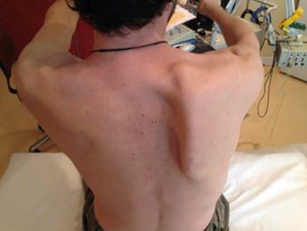 Fig. 3.10, Brachial neuritis and unilateral scapula winging in hepatitis E.