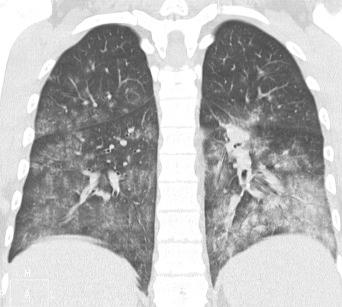 Fig. 4.2, Lung changes in severe acute respiratory syndrome (SARS).