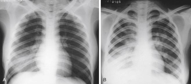 Fig. 4.8, Chest radiographs of a child with H5N1 avian influenza.