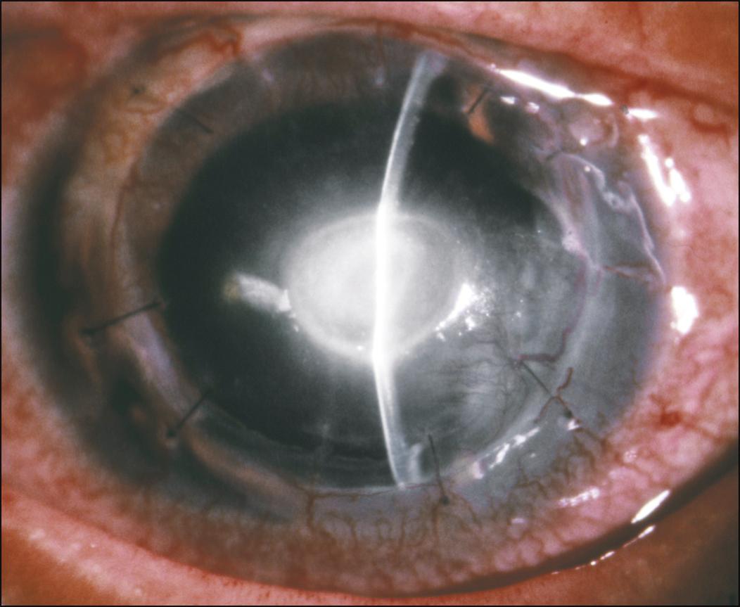 Fig. 116.1, Staphylococcal ulceration located centrally within a graft. Note corneal thinning.