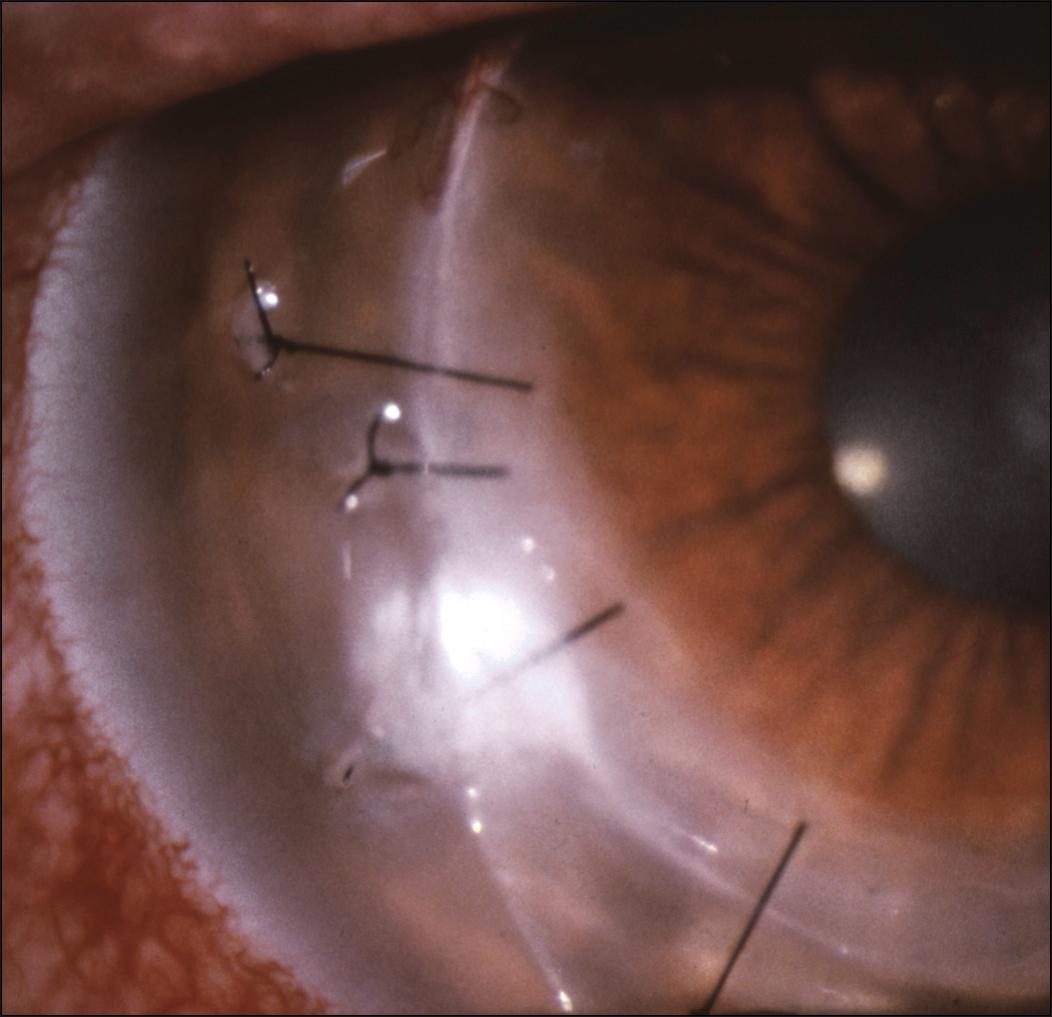 Fig. 116.3, Corneal infiltrate surrounding 10-0 nylon suture at graft-host interface. Note long suture ends, which can contribute to the infectious process.