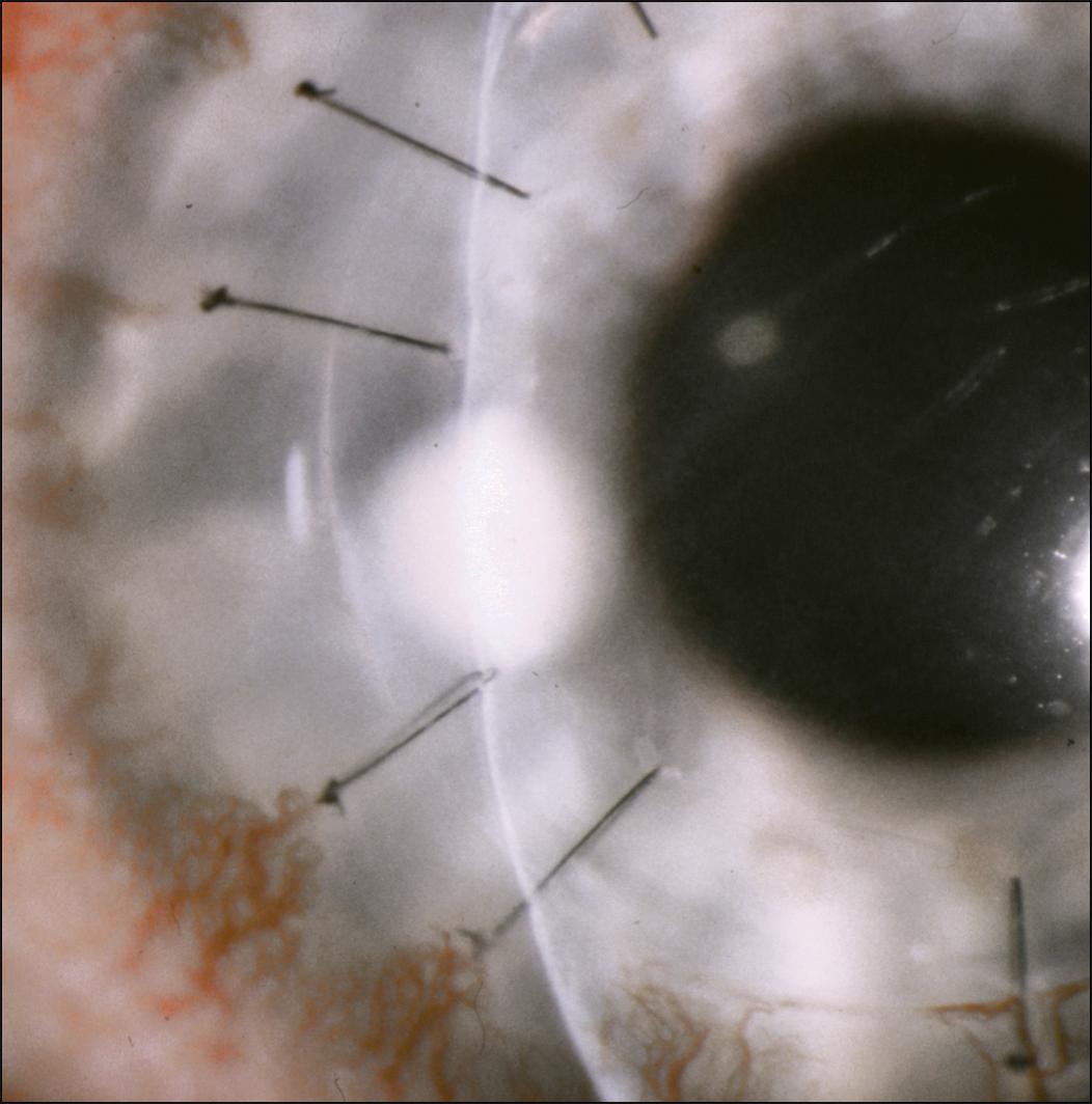 Fig. 116.4, Corneal wound abscess secondary to staphylococcal infection.