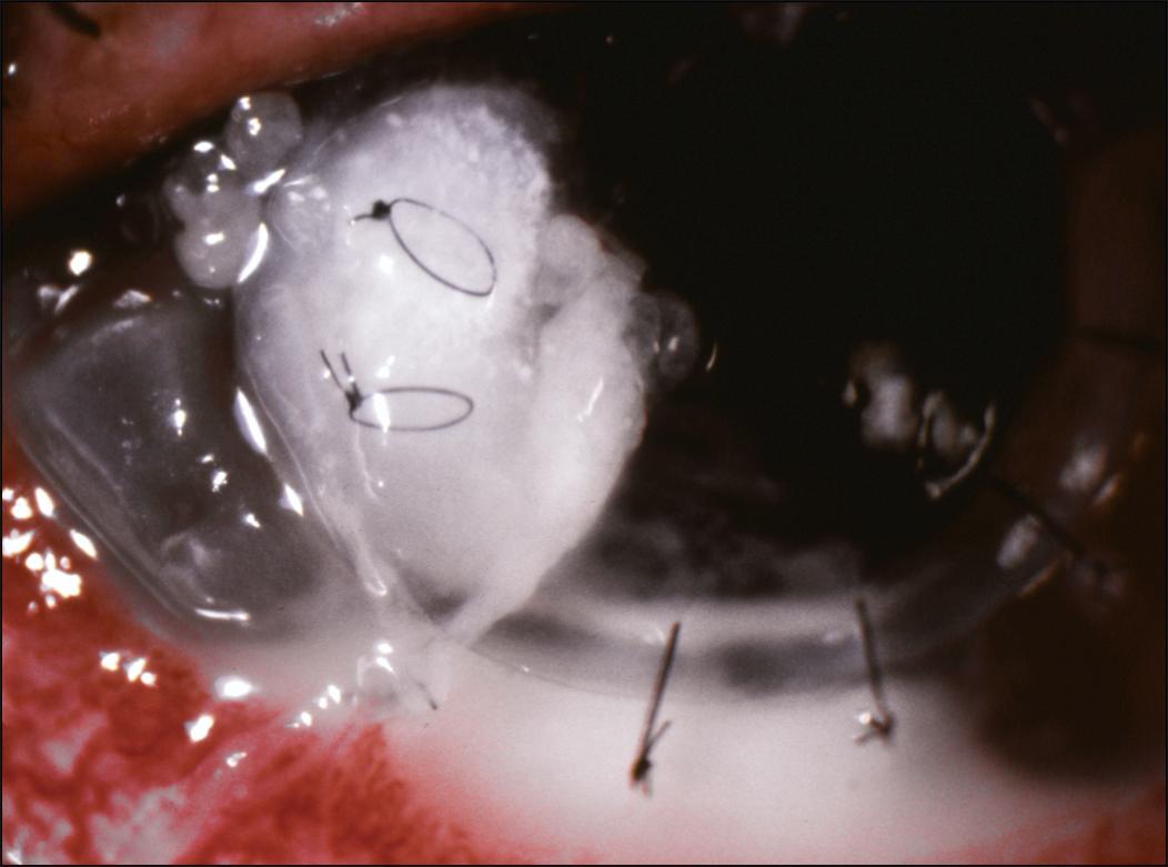 Fig. 116.6, Complete wound dehiscence due to Staphylococcus aureus suture abscess.