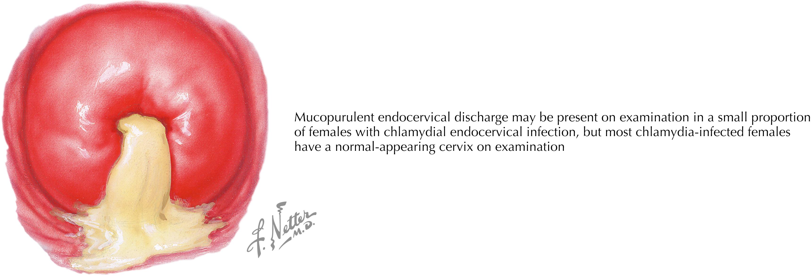 Fig. 58.1, Mucopurulent cervicitis.