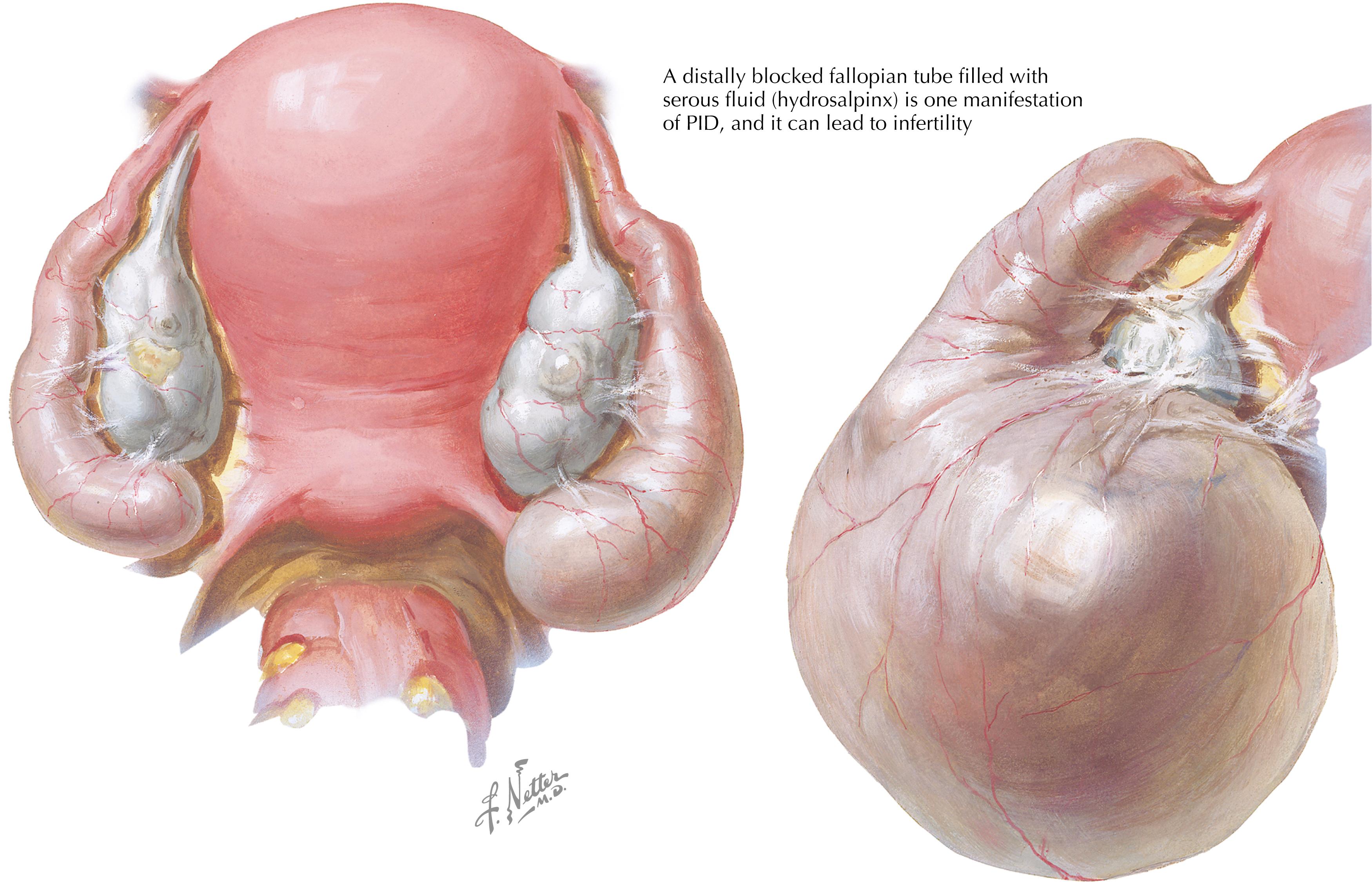 Fig. 58.2, Pelvic inflammatory disease.