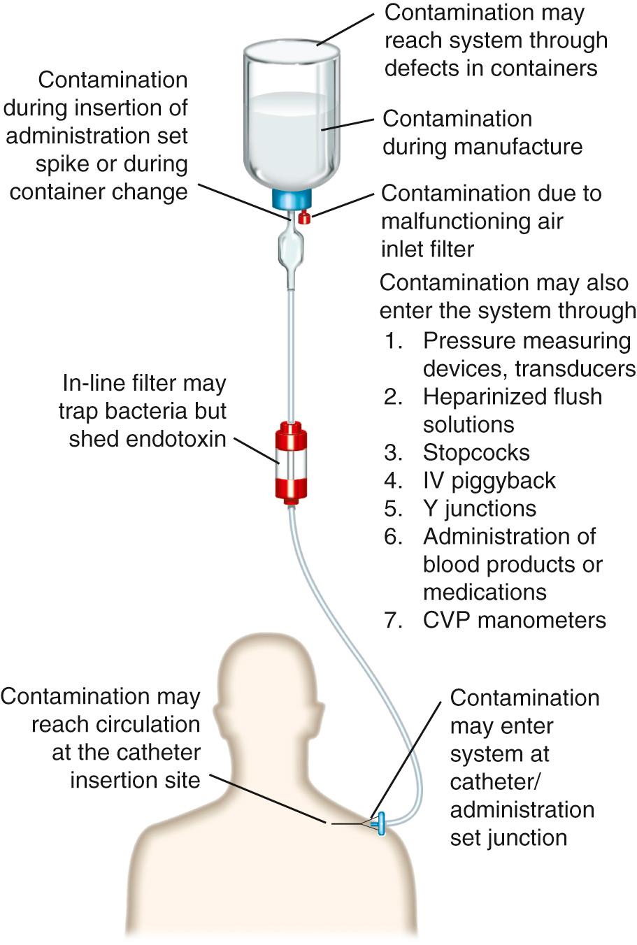 FIG. 300.1, Points of access for microbial contamination in infusion therapy.