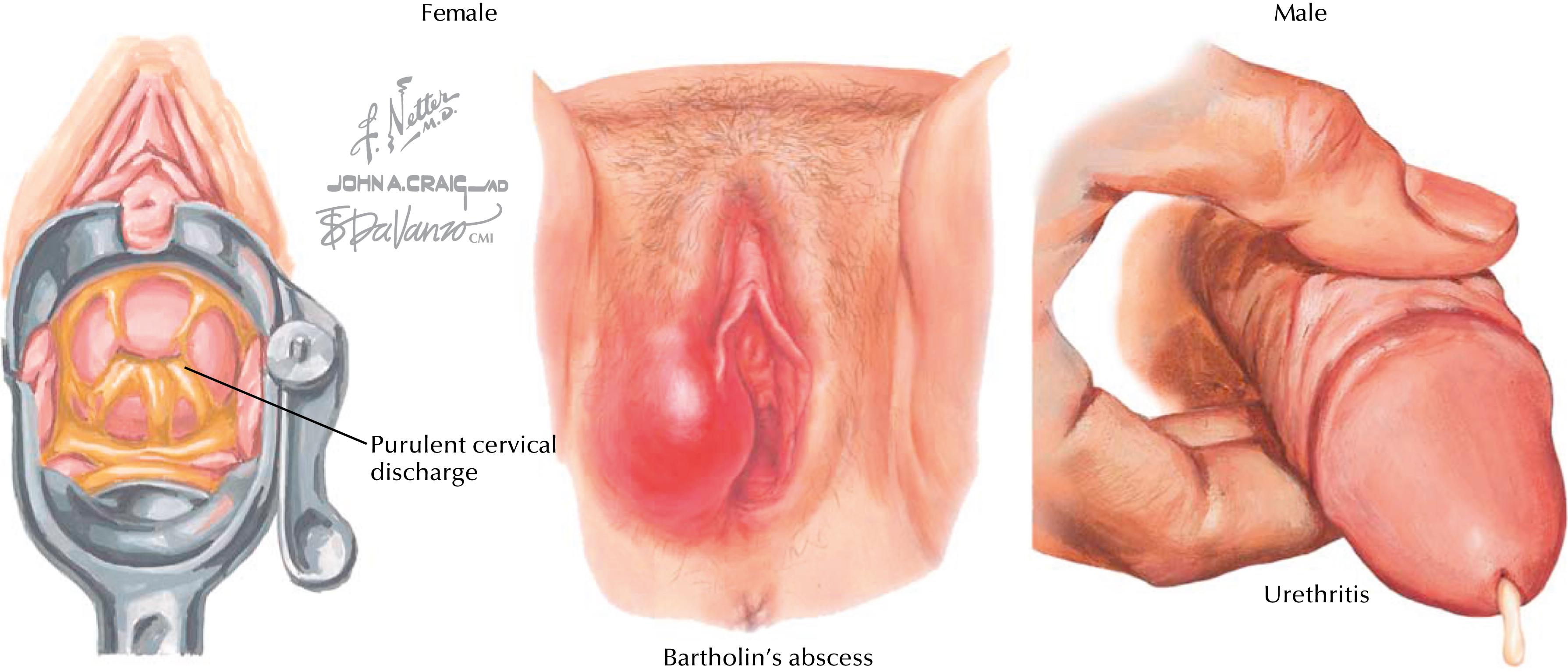 Fig. 59.1, Urogenital manifestations of gonorrhea in men and women.