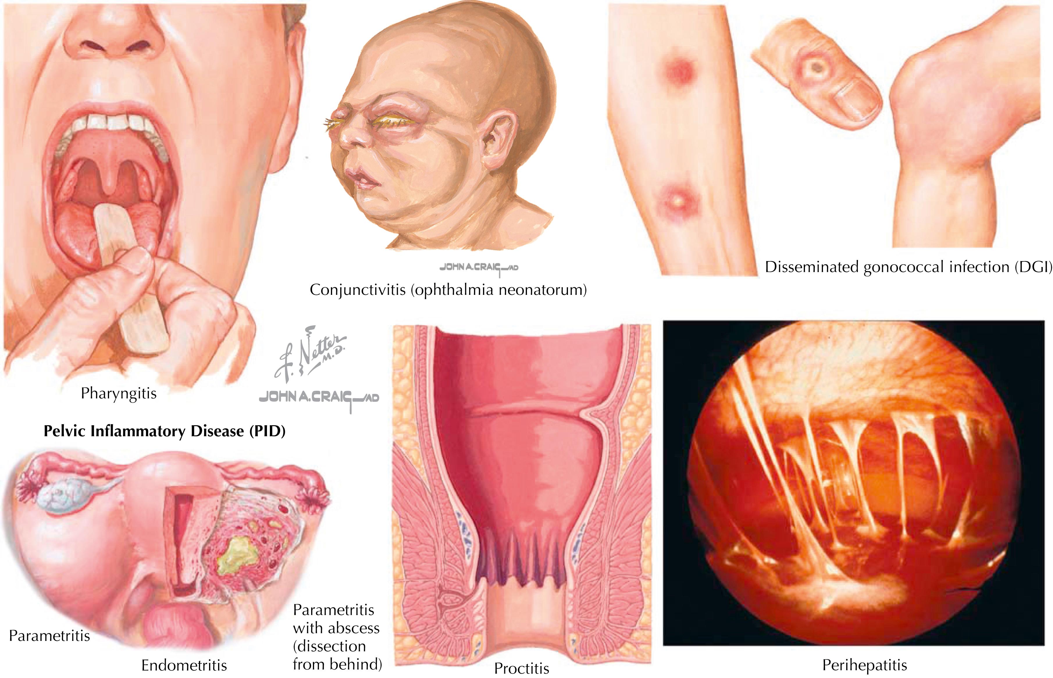 Fig. 59.2, Extragenital manifestations of gonorrhea.