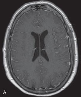 Fig. 23.1, (A) Magnetic resonance imaging (MRI) axial T1 postcontrast image from a 67-year-old patient with bacterial meningitis demonstrates diffuse leptomeningeal enhancement over the convexities of bilateral cerebral hemispheres. (B) MRI axial FLAIR image from a 67-year-old patient with bacterial meningitis demonstrates diffuse hyperintensity within the sulci compatible with exudates from the infection. (C) MRI axial T1 postcontrast image shows enhancement extending superiorly along the anterior aspect or the midbrain and in basilar meninges.