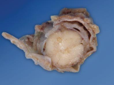 Fig. 23.11, Late sequelae of bacterial meningitis can be severe meningeal fibrosis, as seen in the spinal cord from a 55-year-old man who presented with headache and fever, developed progressive ventricular dilation despite antibiotics and multiple ventriculoperitoneal shunt placements, and was eventually discharged to a rehabilitation facility where he succumbed 3 months later.