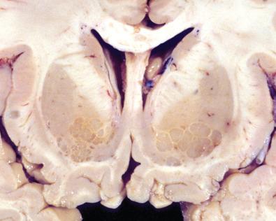 Fig. 23.14, Coronal sections of autopsy brain in patient who succumbed to C. neoformans infection showing cyst-like or “soap bubble” expansion of perivascular Virchow-Robin spaces that are in continuity with the subarachnoid space. The expansion is due to meninges stuffed with numerous encapsulated organisms.