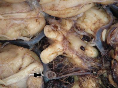 Fig. 23.15, This fungal infection that was vasoinvasive of large caliber blood vessels at the base of the brain in the circle of Willis shows an intravascular thrombi (arrow).