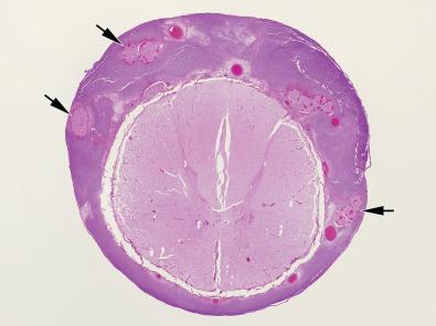 Fig. 23.16, Whole mount section of spinal cord from a patient who succumbed to severe acute bacterial meningitis shows the maximal thickness of the leptomeningeal inflammatory exudate overlying the dorsal region and encompassing nerve roots (arrows).